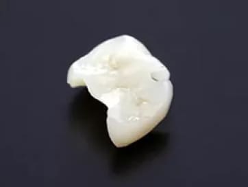 ジルコニアインレー