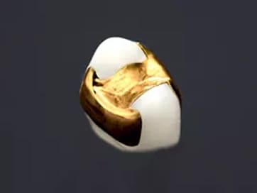 ゴールドインレー（大臼歯・咬合面のみ）